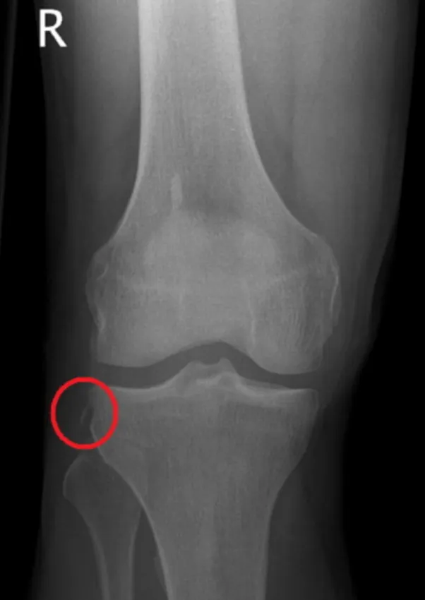 Anterior Cruciate Ligament Tear