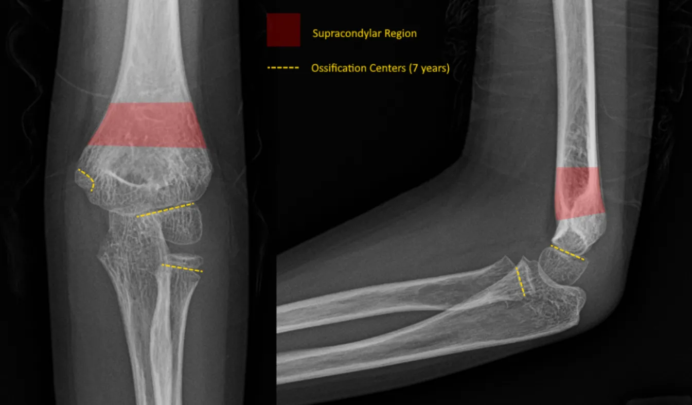 Pediatric Supracondylar Humerus Fracture 3205